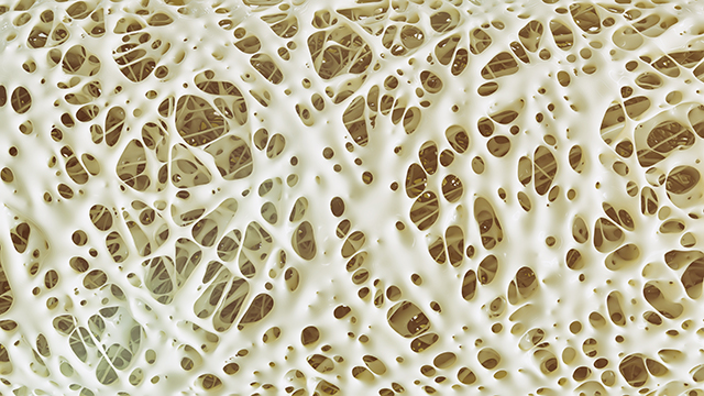 Osteoporosis and men: Pharmaceuticals may increase the risk of bone fractures