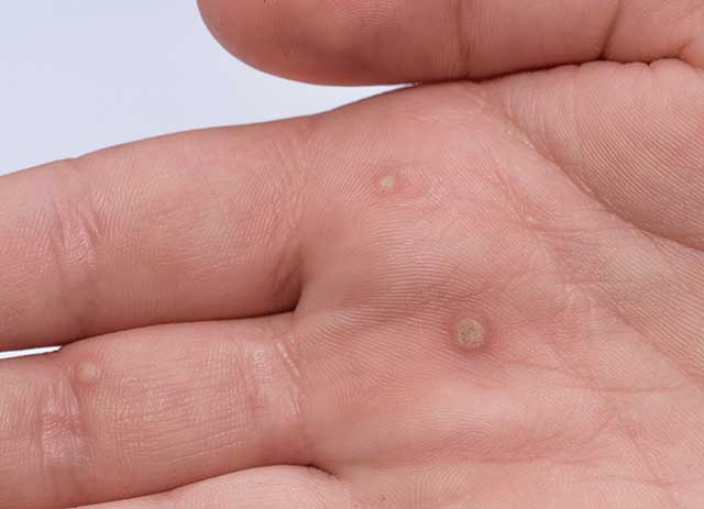 Wart-be-gone: What are warts and how do you treat them at home?